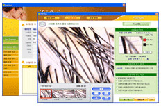 Hairsys alopecia, scalp and hair Analysis software 